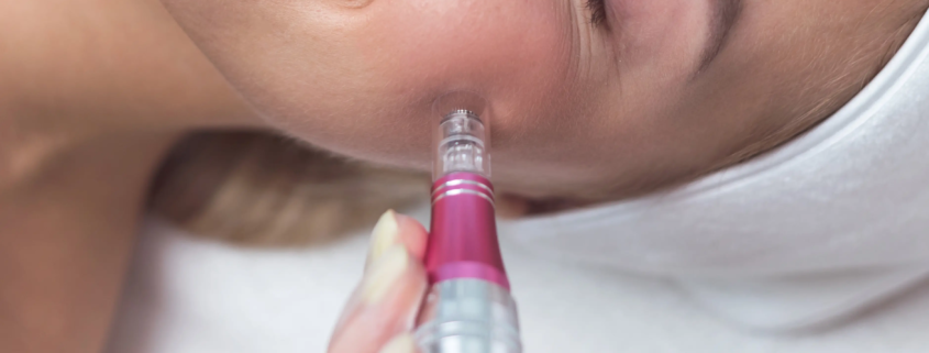 microneedling norrköping